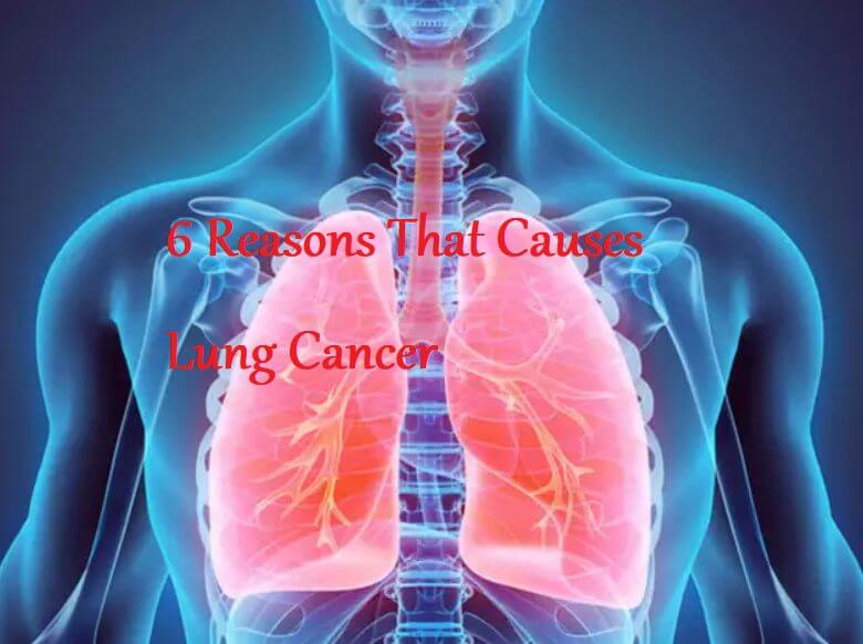 6 Reasons That Causes Lung Cancer – LearningJoan
