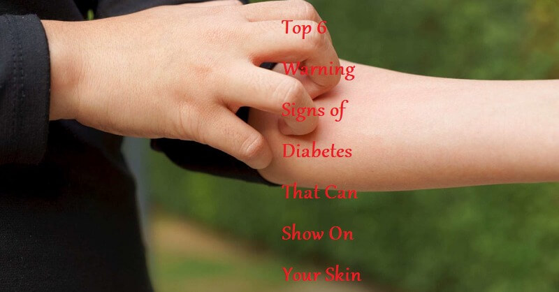 Top 6 Warning Signs of Diabetes That Can Show On Your Skin - LearningJoan