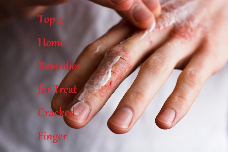 Top 4 Home Remedies for Treat Cracked Finger - LearningJoan