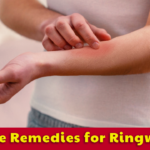 Home Remedies for Ringworm