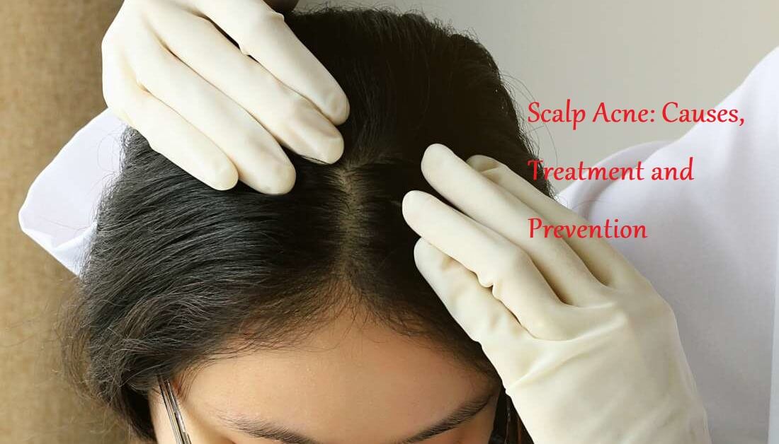 scalp acne