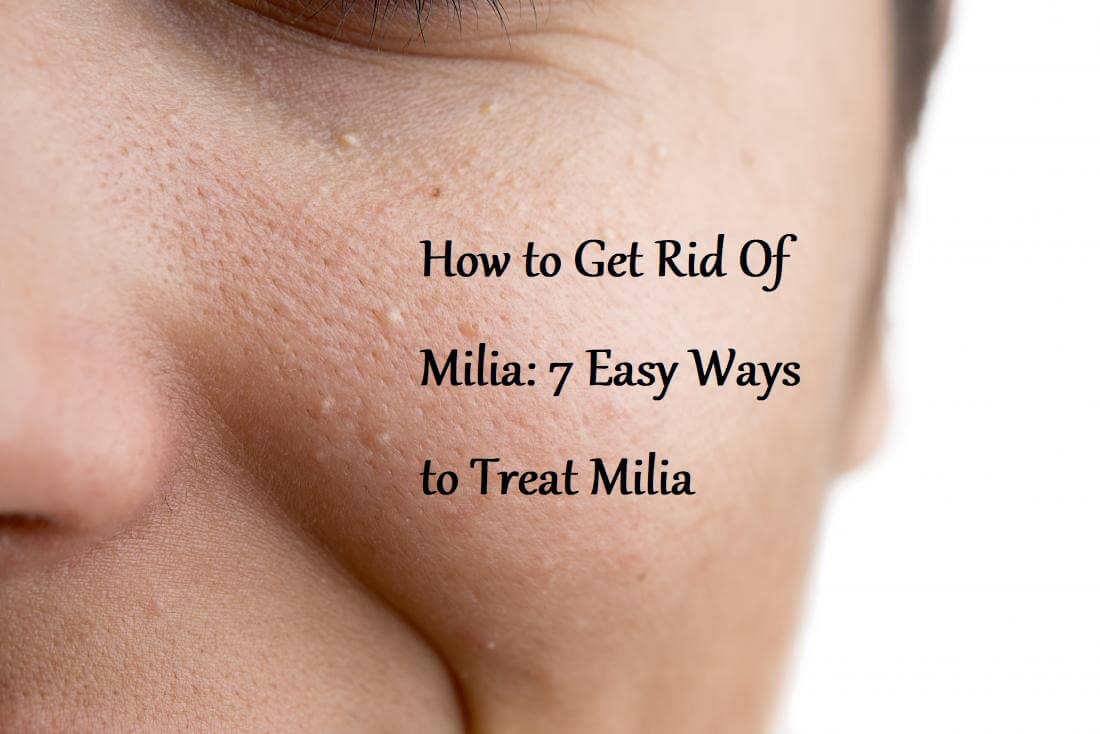 How to Get Rid Of Milia
