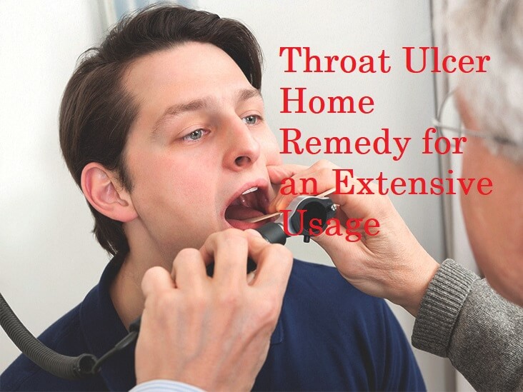 Throat Ulcer Home Remedy