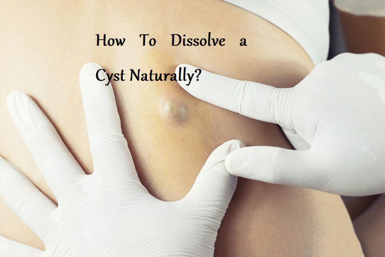 How To Dissolve a Cyst Naturally