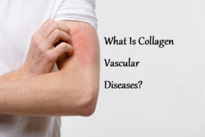 Collagen Vascular Diseases