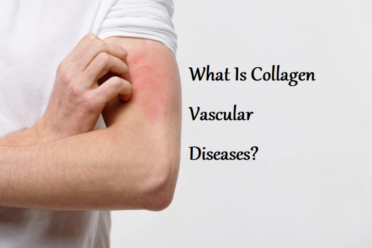 Collagen Vascular Diseases