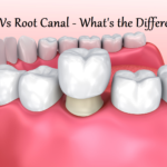 Crown VS Root Canal
