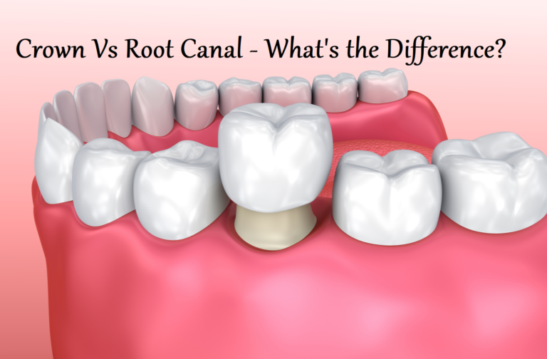 Crown VS Root Canal