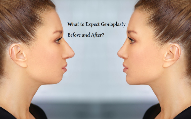 Genioplasty Before and After