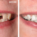 Root Canal Before and After