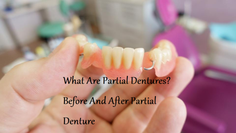 What Are Partial Dentures? Before And After Partial Dentures – Learning Joan