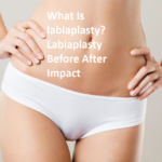 Labiaplasty Before After