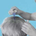 Hair Loss Clinic: Best Hair Restoration Center