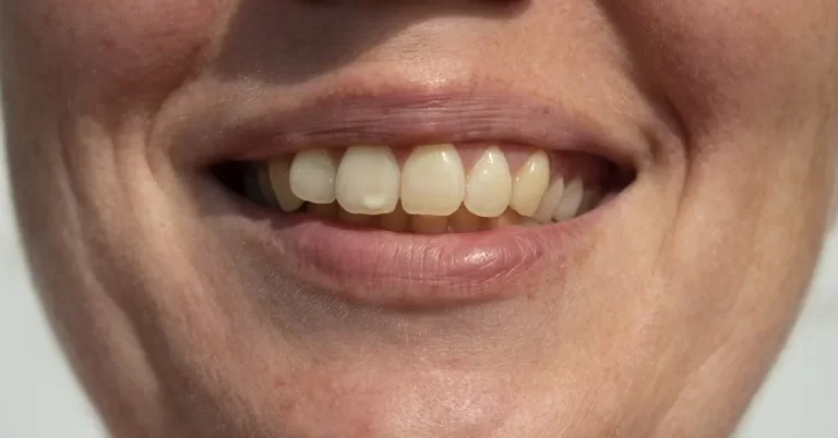 Stained Teeth Looks Ugly and Is Unhealthy Too - Get Rid of It!
