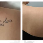 Tattoo Regret - Laser Tattoo Removal Toronto