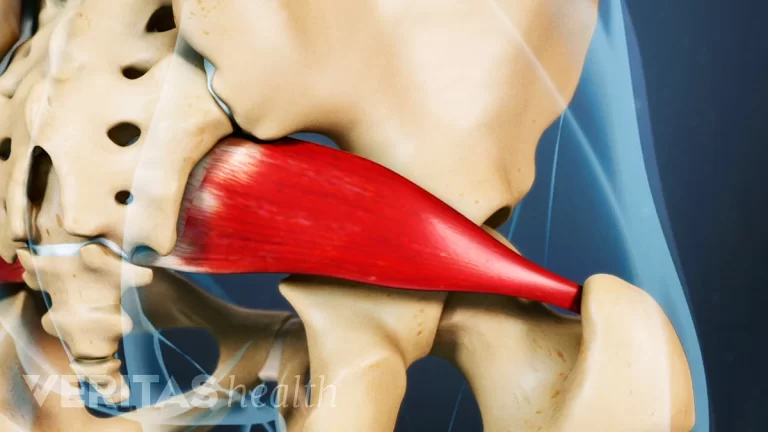 Piriformis Syndrome: Causes, Relief, and Prevention
