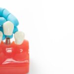 Dental Implants jackson tn