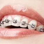 Spanish speaking orthodontist the woodlands tx