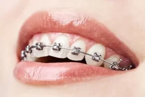 Spanish speaking orthodontist the woodlands tx