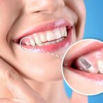 Tooth Replacement - What Types of Dental Implants Are Available?