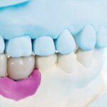 dental bridges prairieville la