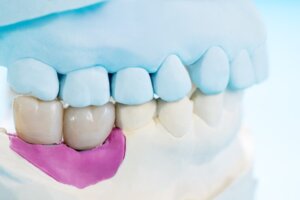 dental bridges prairieville la