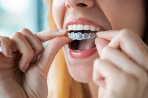 invisalign cost tallahassee fl