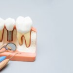 dental implants near macon ga