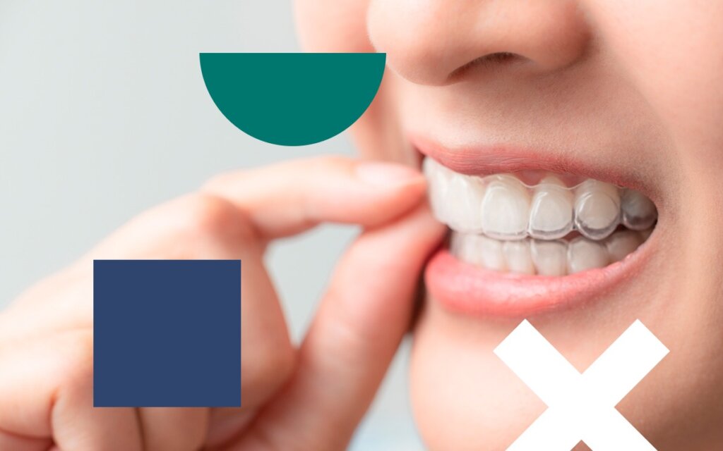 Everything You Need to Know About Clear Aligners