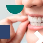 Everything You Need to Know About Clear Aligners