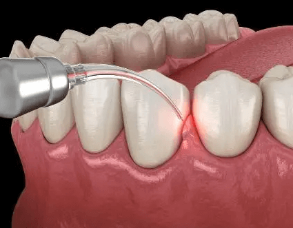 periodontal therapy vista ca