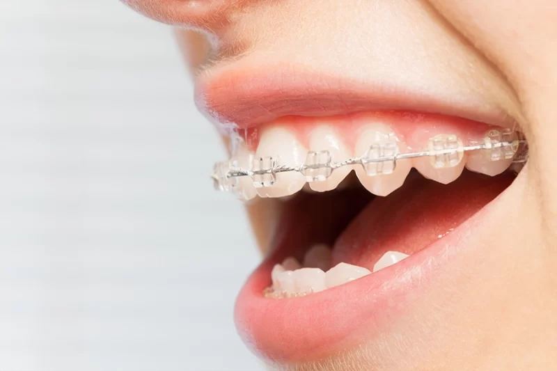 Clear Braces in The Woodlands, TX: The Discreet Path to a Straighter, Healthier Smile