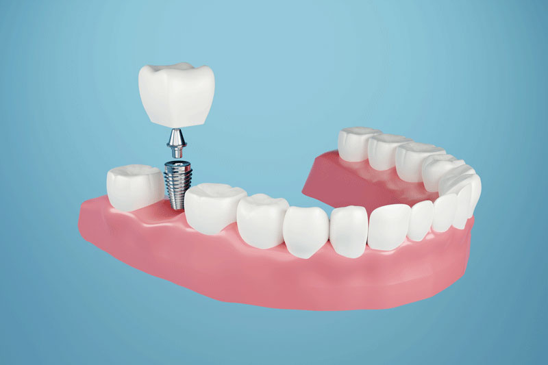 Dental Implants in Cantonment, FL: The Complete Guide to Replacing Missing Teeth for Good