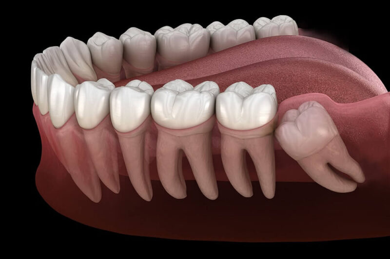Everything You Should Know Before Getting Your Wisdom Teeth Removed in Franklin, KY
