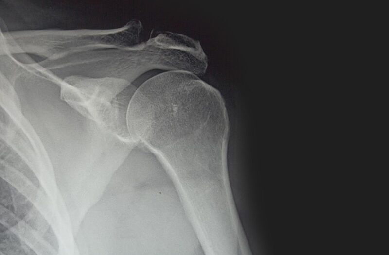 Hairline fracture healing time: what to expect week by week