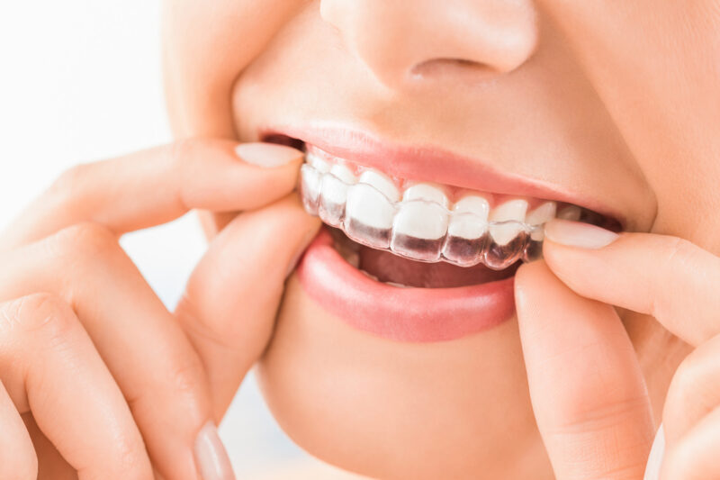 Straighten Your Smile Discreetly: Your Guide to Finding an Invisalign Dentist in Trussville, AL
