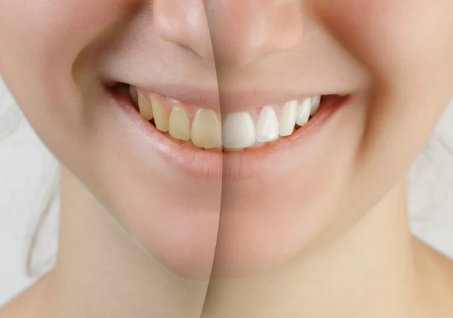 Teeth Whitening in Lincoln, AL: Everything You Need to Know Before Brightening Your Smile