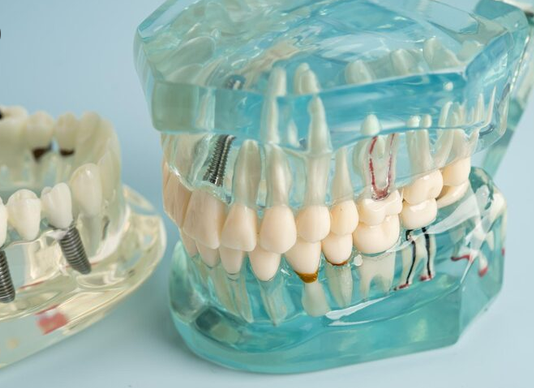 All on 4 Dental Implants Pikeville KY: A Complete Solution for Restoring Your Smile