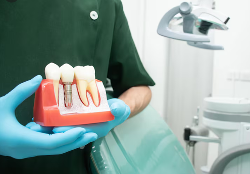 Implant Dentistry in Hickory, NC: A Practical Guide to Modern Tooth Replacement