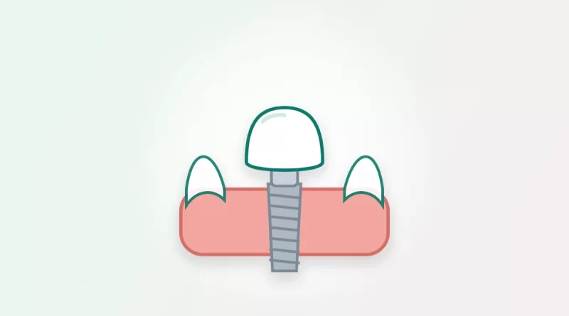 Illustration of a dental implant with a metal post and crown set in the gum between natural teeth