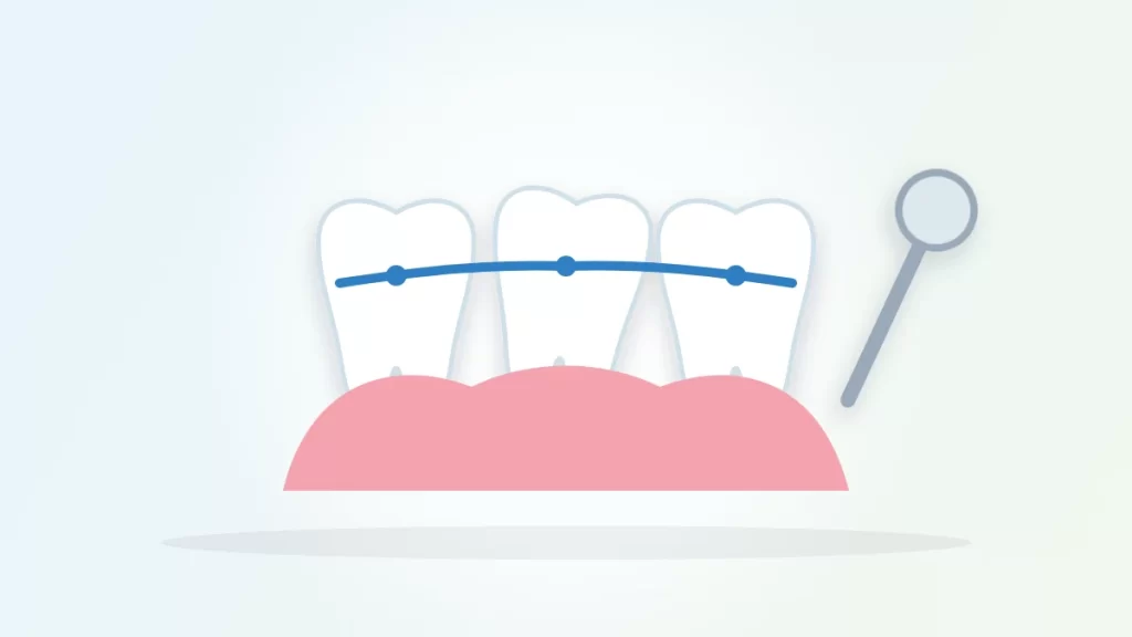 How to fix a loose tooth illustration: three teeth held together by a dental splint above the gums, with a dental mirror