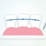 How to fix a loose tooth illustration: three teeth held together by a dental splint above the gums, with a dental mirror