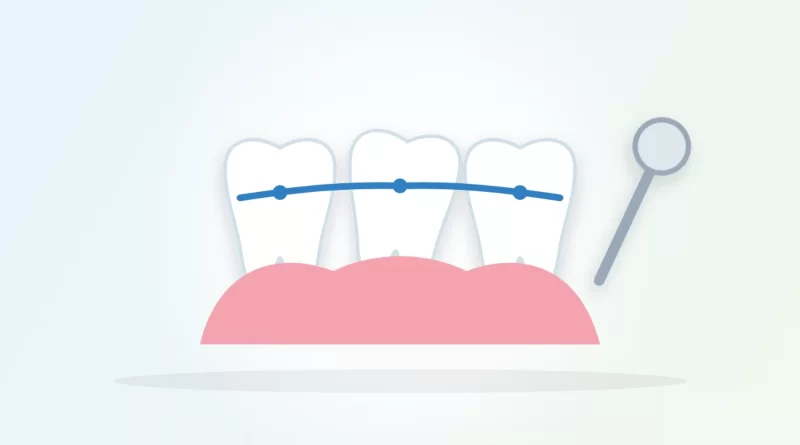 How to fix a loose tooth illustration: three teeth held together by a dental splint above the gums, with a dental mirror