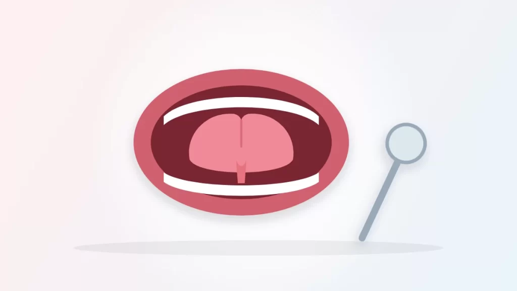 Tongue tie in adults illustration: an open mouth with the tongue lifted to show a short band of tissue underneath, beside a dental mirror