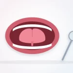 Tongue tie in adults illustration: an open mouth with the tongue lifted to show a short band of tissue underneath, beside a dental mirror