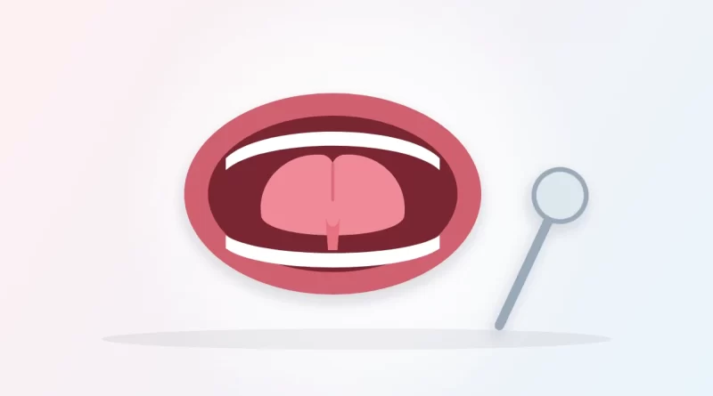 Tongue tie in adults illustration: an open mouth with the tongue lifted to show a short band of tissue underneath, beside a dental mirror