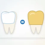 Veneers vs crowns illustration: a tooth with a thin front shell beside a tooth with a full cap