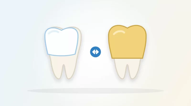 Veneers vs crowns illustration: a tooth with a thin front shell beside a tooth with a full cap
